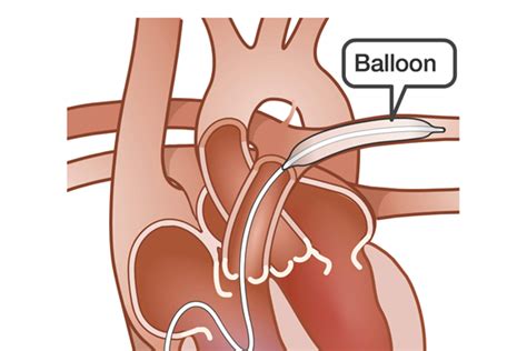 Balloon Pulmonary Angioplasty Pha