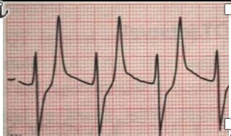 EKG Exam 1 Electrolytes Misc Findings Flashcards Quizlet