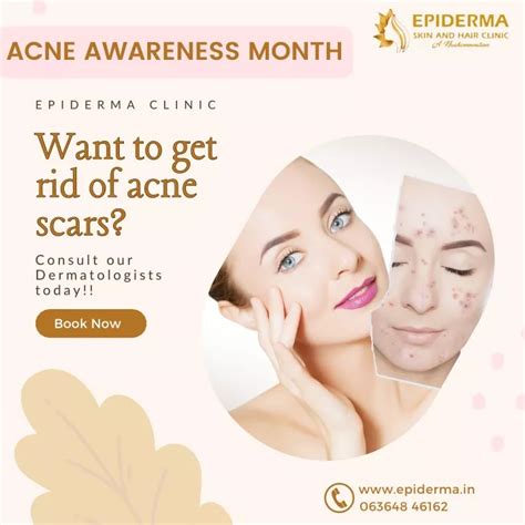 Ppt Get Rid Of Acne Scars Epiderma Skin And Hair Clinic Jayanagar Bangalore Powerpoint