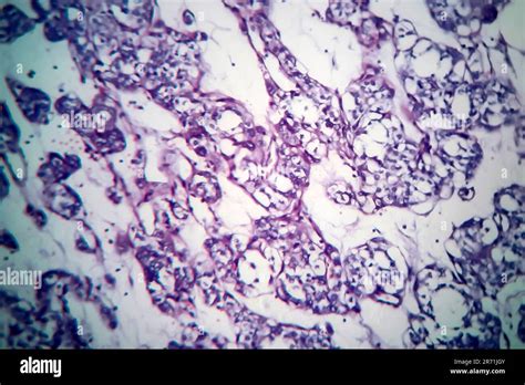 Carcinoma Folicular Tiroideo Micrograf A De Luz Foto Al Microscopio