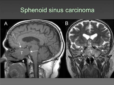 The Clivus Lesions Crossroads Of Skull Base Semantic Scholar