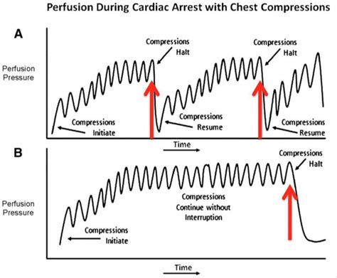 High quality chest compressions are a vital component of CPR. Try to keep pauses to a minimum # ...