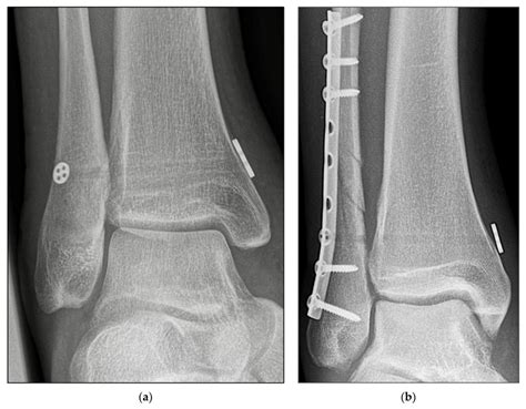 Radiographic Imaging A Anteroposterior View Of Isolated Knotless Download Scientific Diagram