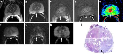 Axial T2 Weighted Fast Spin Echo Image 5525 110 And B Axial