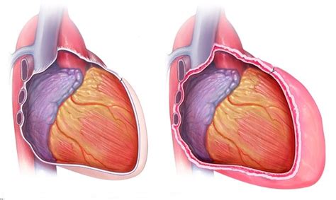 Pericardite Constrictiva O Que Causas E Tratamentos Dicas De Sa De