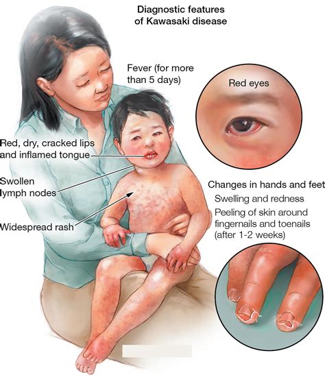 Kawasaki Disease Causes Signs Symptomstreatment