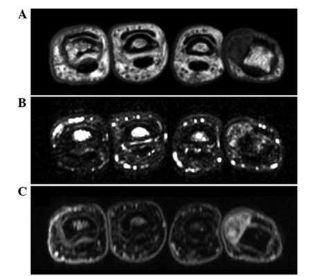 Axial Magnetic Resonance Imaging Showing A Relatively Well Defined Soft