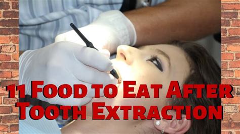 What To Eat After A Tooth Extraction A Guide To Soft And Soothing Foods Cecil Blices Blog