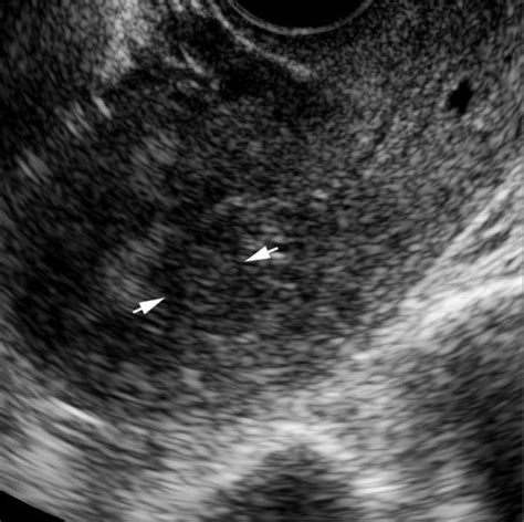 Submucosal Leiomyoma Longitudinal Transvaginal Pelvic Sonogram From A Download Scientific