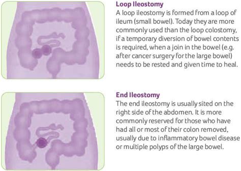 Ileostomy Loop Ileostomy End Ileostomy Diet Complications