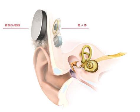 欧洲首例全植入人工耳蜗手术听力