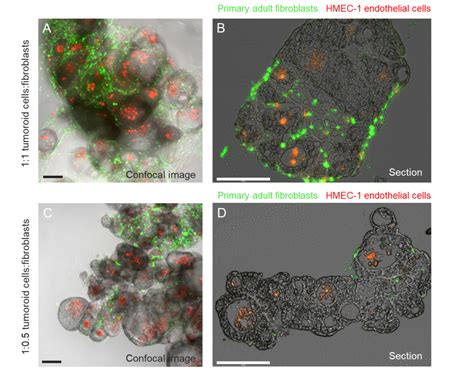 Co Culturing Patient Derived Cancer Organoids With Fibroblasts And