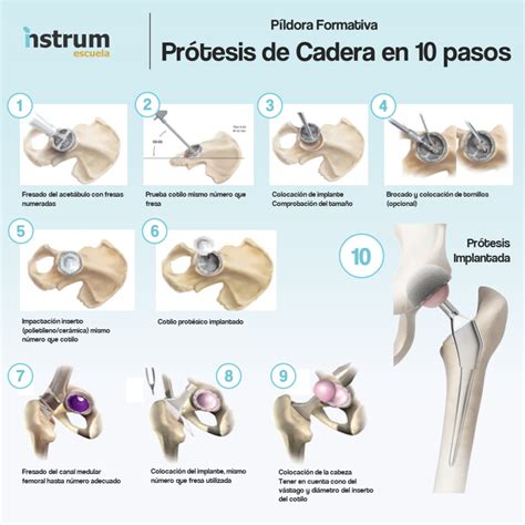 PÍLDORA FORMATIVA Prótesis de Cadera en 10 pasos Instrum