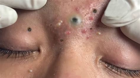 Big Cystic Acne Blackheads Extraction Blackheads And Milia Whiteheads Removal Pimple Popping Youtube