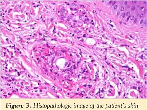 Figure 3 from Henoch Schönleinova purpura pri odraslem Henoch Schönlein