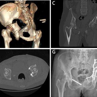 Preoperative And Postoperative Imaging Evaluation A D Preoperative CT