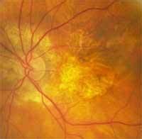 Maculopathy: Causes and Symptoms