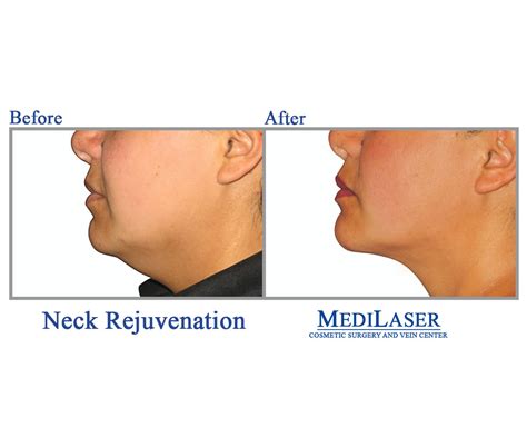 Neck Rejuvenation Lift Lipo Liposuction Renuvion Skin Tightening Medilaser Frisco Texas