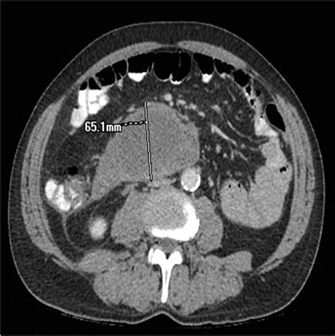 Superior Mesenteric Artery Branch Pseudoaneurysm Mimicking An Acute