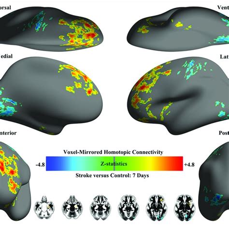 Whole Brain Surface Renderings Of Group Differences In Vmhc Between