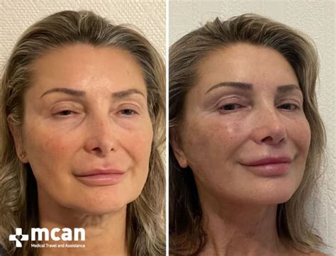 Lifting Facial Ritidectom A En Turqu A Mcan Health