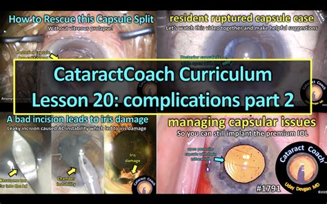 1791 Curriculum Lesson 20 Complications Part 2 Cataract Coach™