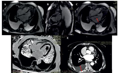 Cardiac Magnetic Resonance A B Left Ventricular Apical Obliteration Download Scientific