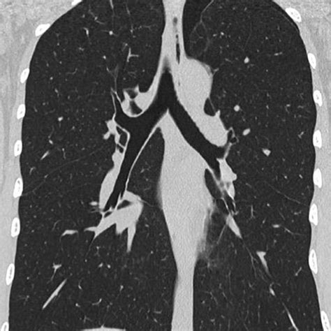 Lung imaging. (a) Chest X-ray. A total collapse of the left lung was... | Download Scientific ...