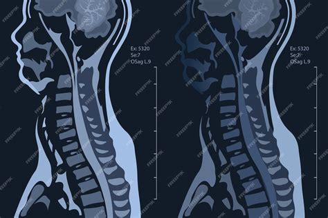 Premium Vector Magnetic Resonance Imaging Of The Cervical Spine Spine