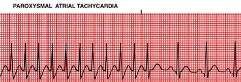 Paroxysmal Atrial Tachycardia Health Science Ekg Medical