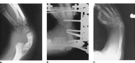 Figure From Congenital Deformities Of The Upper Extremity Semantic 5940 Hot Sex Picture