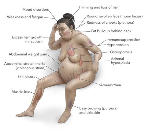 Unveiling Cushing S Syndrome Understanding Its Causes And Effects