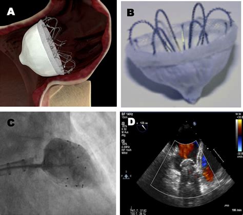 Percutaneous Left Atrial Appendage Occlusion For Stroke Prevention In