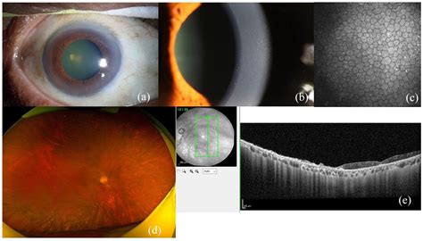 Reactivation Of Varicella Zoster Infection Presenting As Acute Retinal