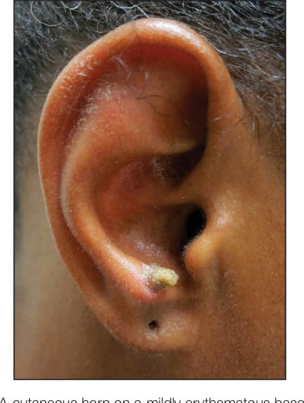 Figure From Cutaneous Sarcoidosis Presenting As A Cutaneous Horn