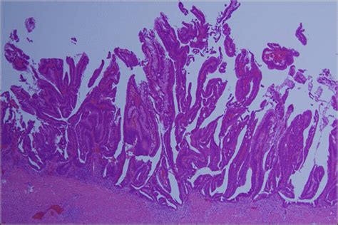 Histologically The Tumor Characterized By Hyperchromatic Cells With