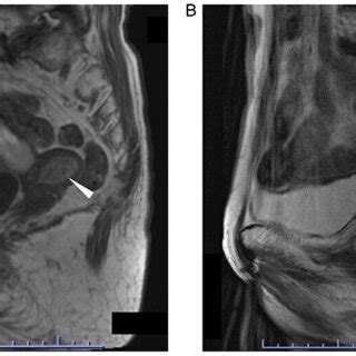 MRI A T1 Weighted Image A 26 6x16 6 Mm High Intensity Lesion Was