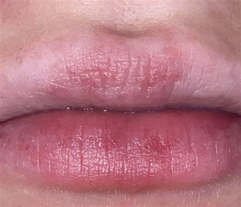 Lip rash started around a month or two ago : r/DermatologyQuestions