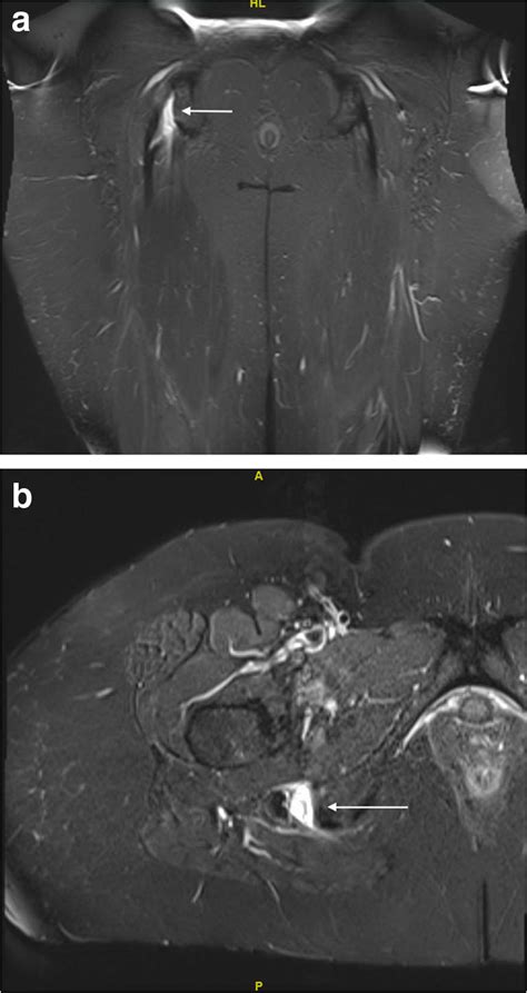 Hamstring Tendon Tear Mri