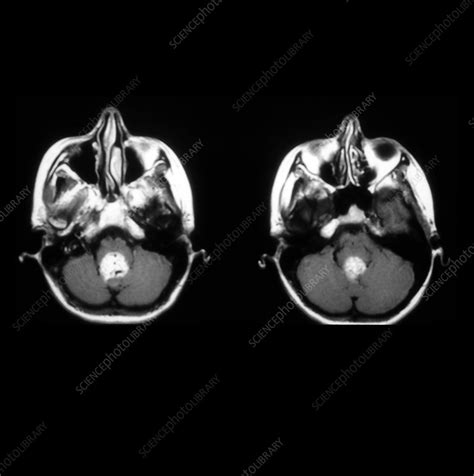 Mri Of Hemangioblastoma Stock Image M1360317 Science Photo Library