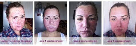 Лазерная шлифовка лица в Москве, цены - клиника “Косметомед”