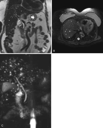 Body Mri Flashcards Quizlet