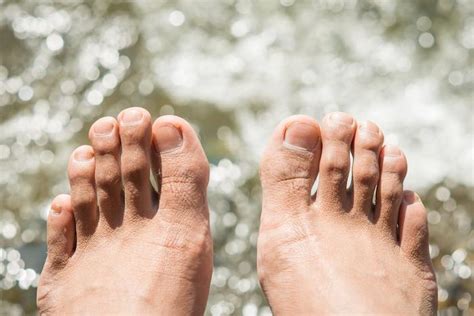 5 Tips For Preventing Stubborn Toenail Fungus This Summer South Sound