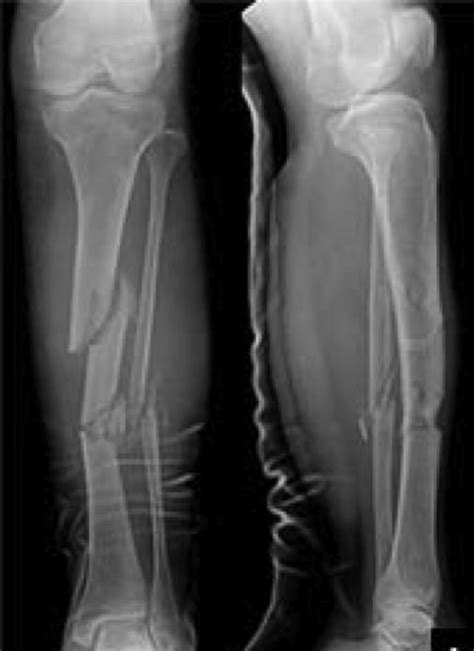 Tibial Shaft Fractures Trauma Orthobullets