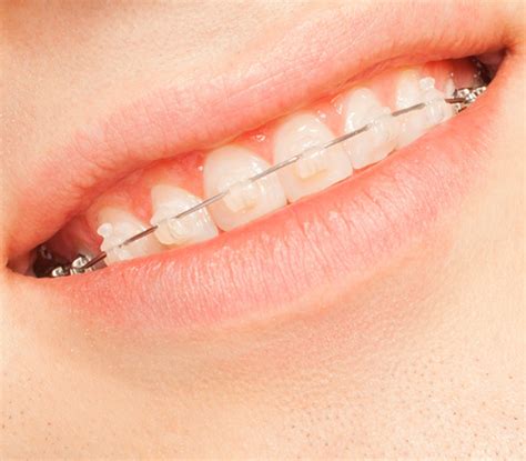 Clear Braces Canberra Ceramic Braces Embrace Orthodontists