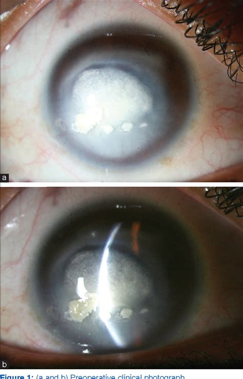 Figure 1 From Acute Interface Infectious Keratitis With Multidrug Resistant Klebsiella And