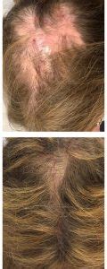 Hair Loss Restoration Scalp Regeneration Via Botox Like Treatment Dr