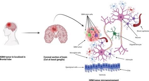 Formation Of Gbm Tumors And Their Microenvironment Gbm Tumors Are