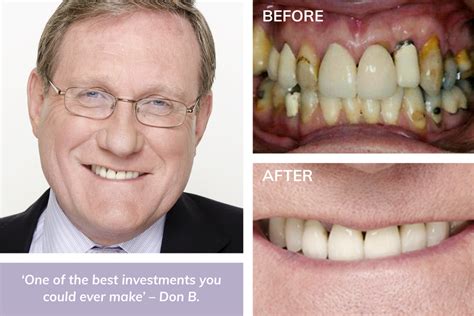 Dental Implants Gallery Improve Your Smile