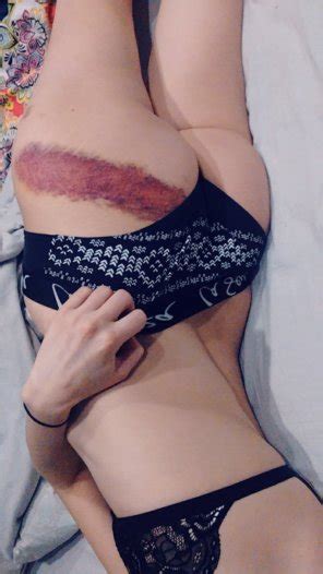F My Bruise Was So Pretty Porn Pic